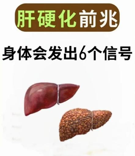 早期肝硬化6个报警信号，早发现，早治疗，可逆转！ 肝硬化是一种较严重的