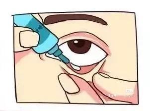 滴滴眼液姿势很关键，别直接往眼球上滴。把头仰起来，拉开下眼皮弄出个小口袋，瓶口悬