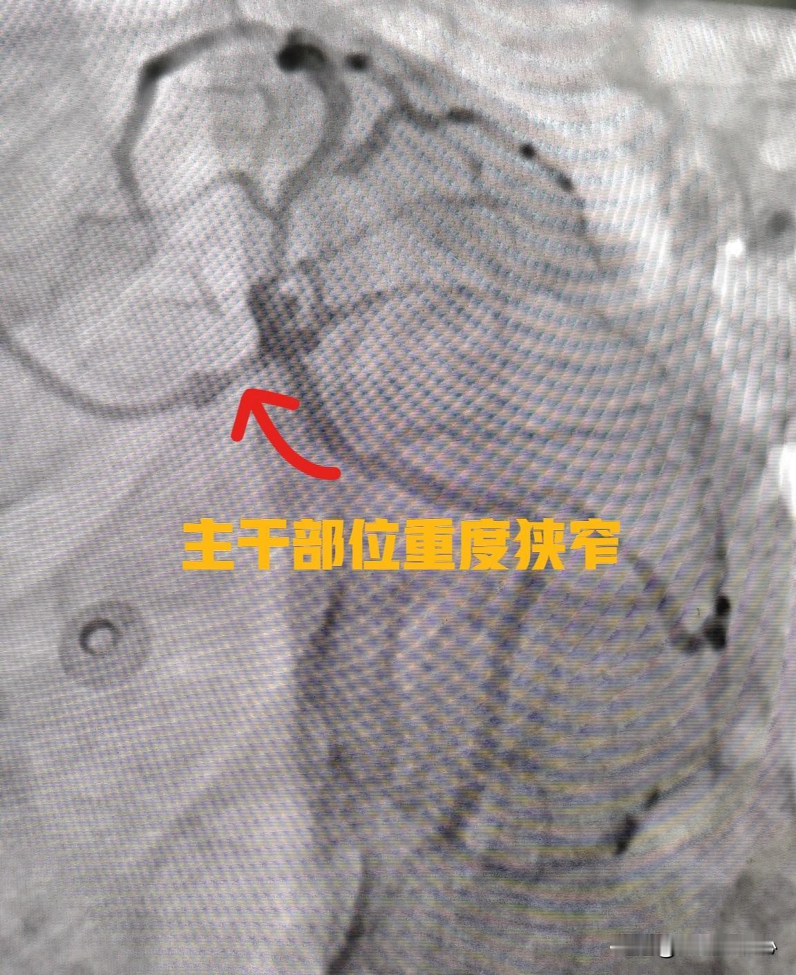 冠心病总体来讲有三种治疗方案，第一种就是药物治疗，药物治疗的主要目的是缓解心绞痛