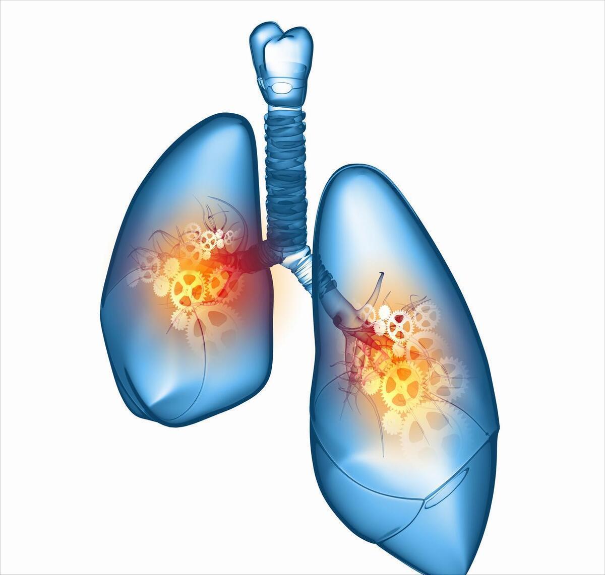 什么人容易患肺部结节，什么样的习惯会导致结节癌变，值得收藏肺结节是个发病率很高