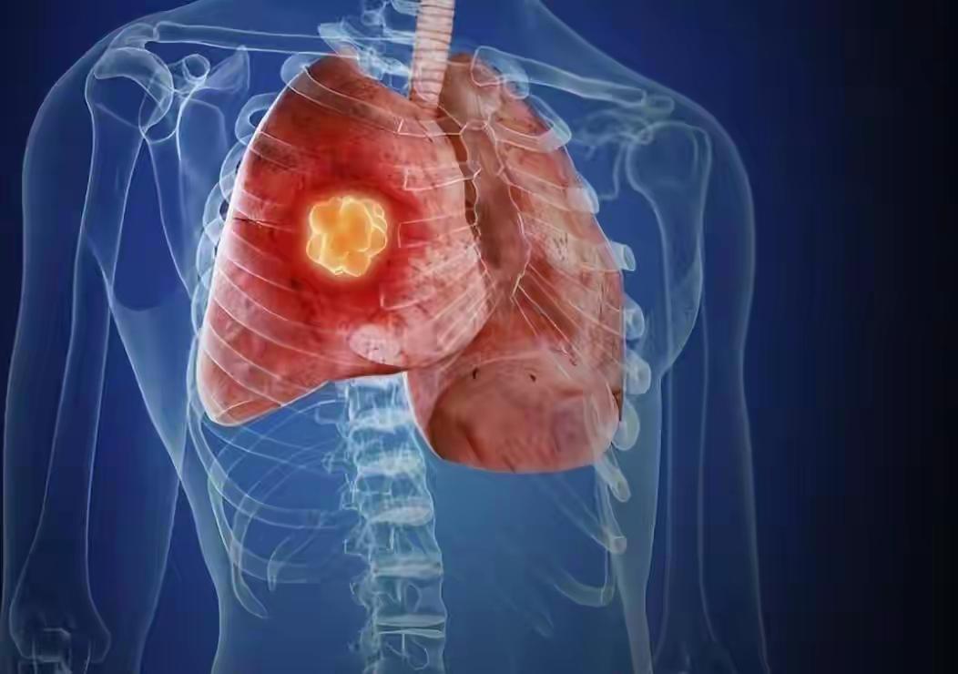 ​要想远离肺癌，除了拒绝吸烟之外，更多的还是注重以下几方面可以远离癌症。从大量的