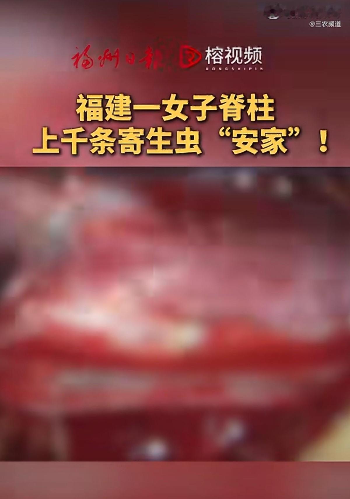 骇人听闻的罕见病例！第一眼新闻5月15日报道，福建福州，一57岁农村妇女李女士被