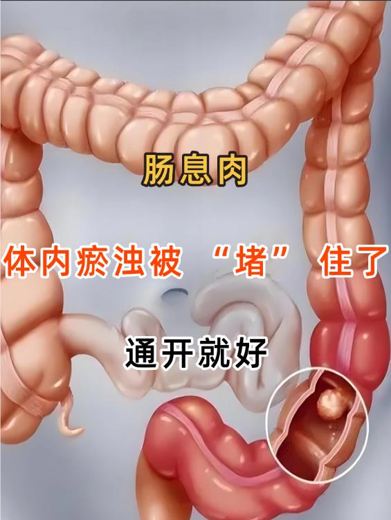 肠息肉其实是体内瘀浊被“堵”住了，通开就好在中医中，肠息肉并非一种独立的