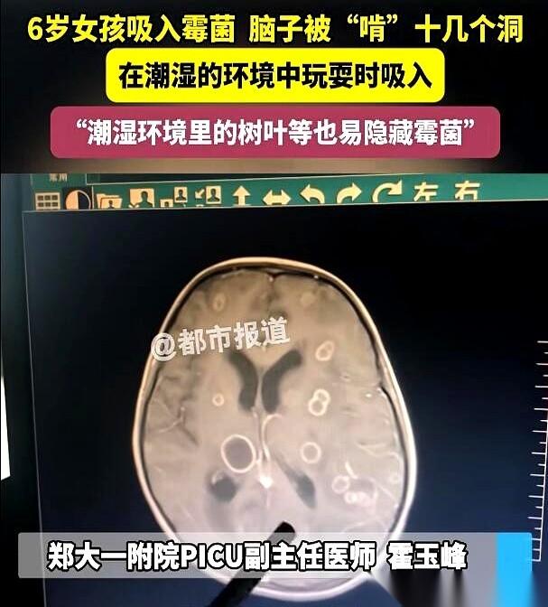 郑州一个6岁女孩，连着发烧17天，人烧得都迷糊了。送到医院，片子一出来，医生对