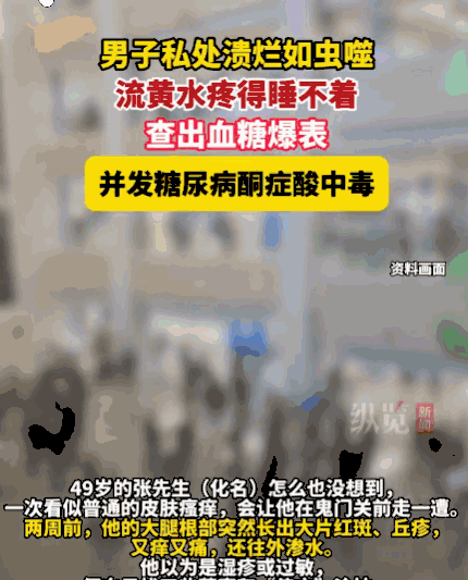 太大意了！深圳，一49岁的男子大腿根突发红斑丘疹，又痒又痛。他误以为是湿疹，自行