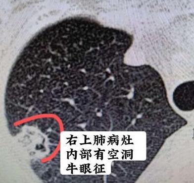 这真是一个令人惋惜的病例，错过最佳治疗时机，肿瘤已经转移了！患者是一位50多岁的