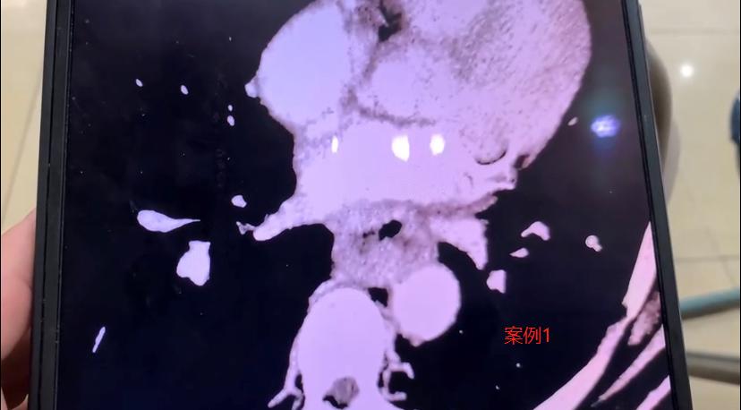 先手术还是先化疗？两位食管癌患者的不同选择，结局差别很大！1、59岁的大哥，