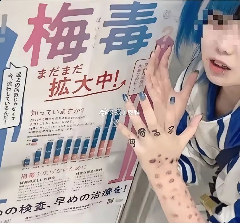 日本梅毒大范围扩散不少年轻人扎堆公开“晒梅毒”没得病的还专门化妆模仿！