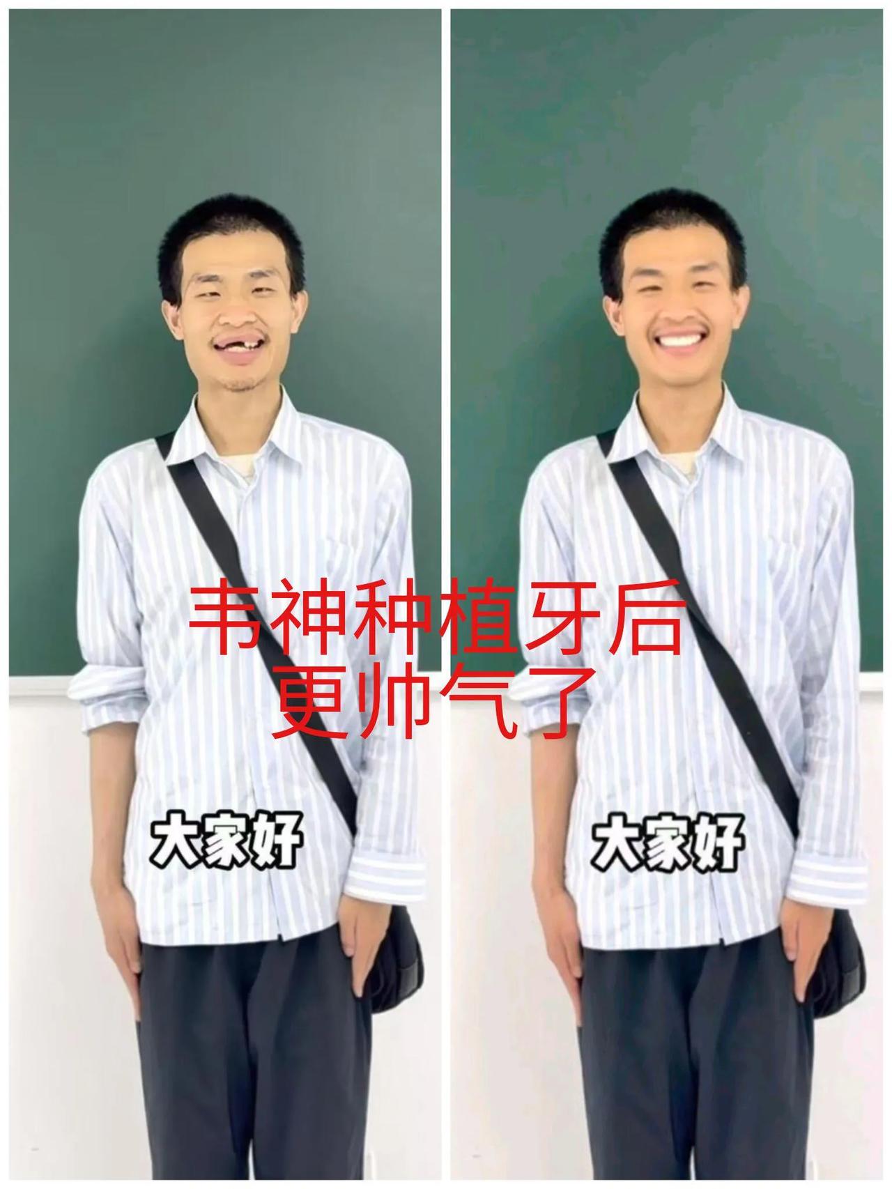 韦神（韦东奕）的牙确实需要补一下。从健康的角度考虑，有一口好牙，才能吃各种食物