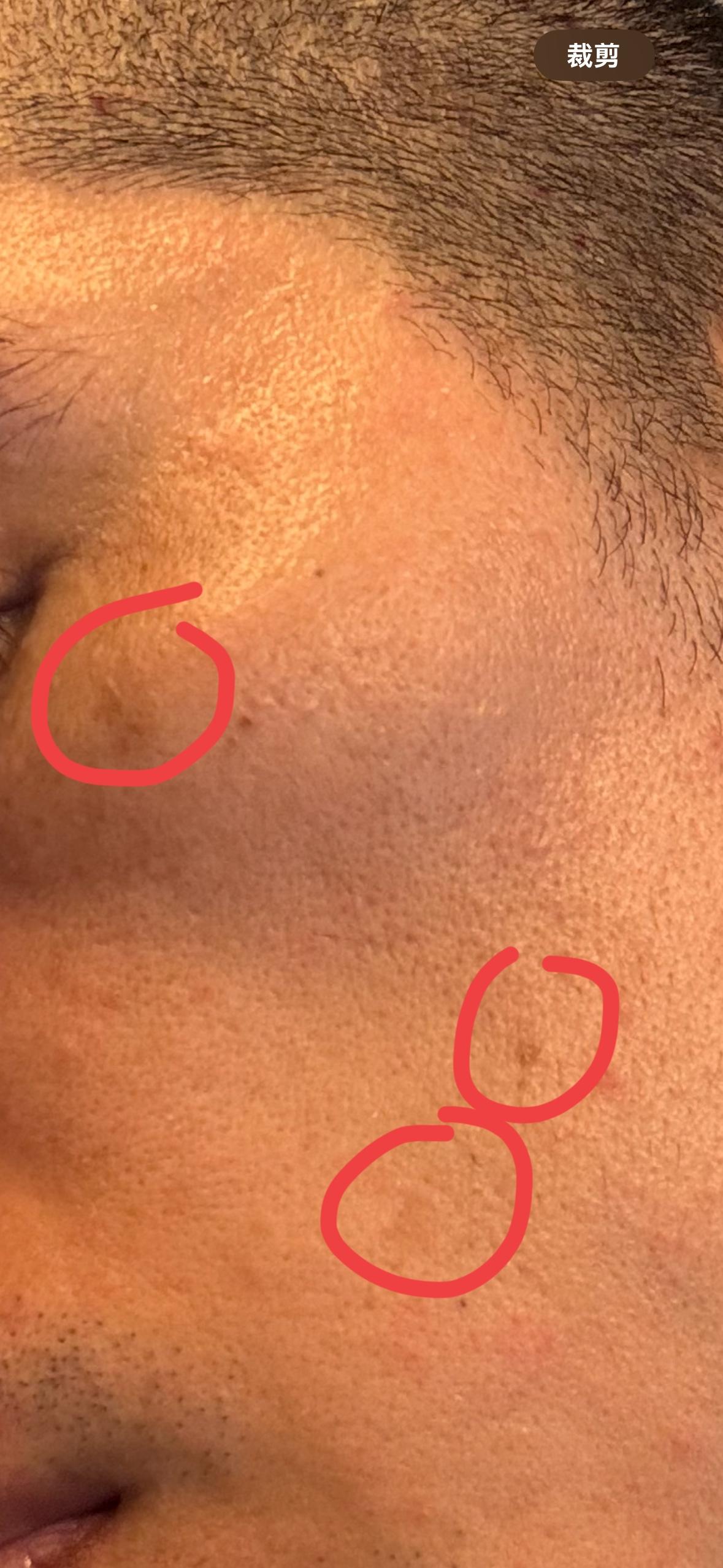 80后的你开始长斑了吗？我是81年的，不知道什么时候起，脸上居然开始长斑了，