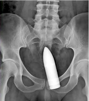 法国一名24岁的男子在将一个物体插入自己的直肠后被送进了医院。医生们发现这是