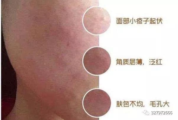 朵嘉浓晓晓: 激素脸为什么干燥、紧绷、水分容易流失? 即使补水还是干呢