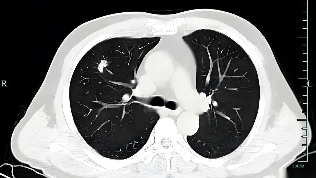 CT报告一出来，魂儿先没了一半。磨玻璃结节、索条影、钙化灶……一堆看不懂的名