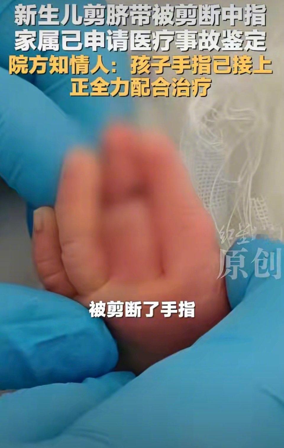 太离谱了吧！剪脐带剪断新生儿的手指！不知道这助产士在干吗？脐带和手指的差距还是很