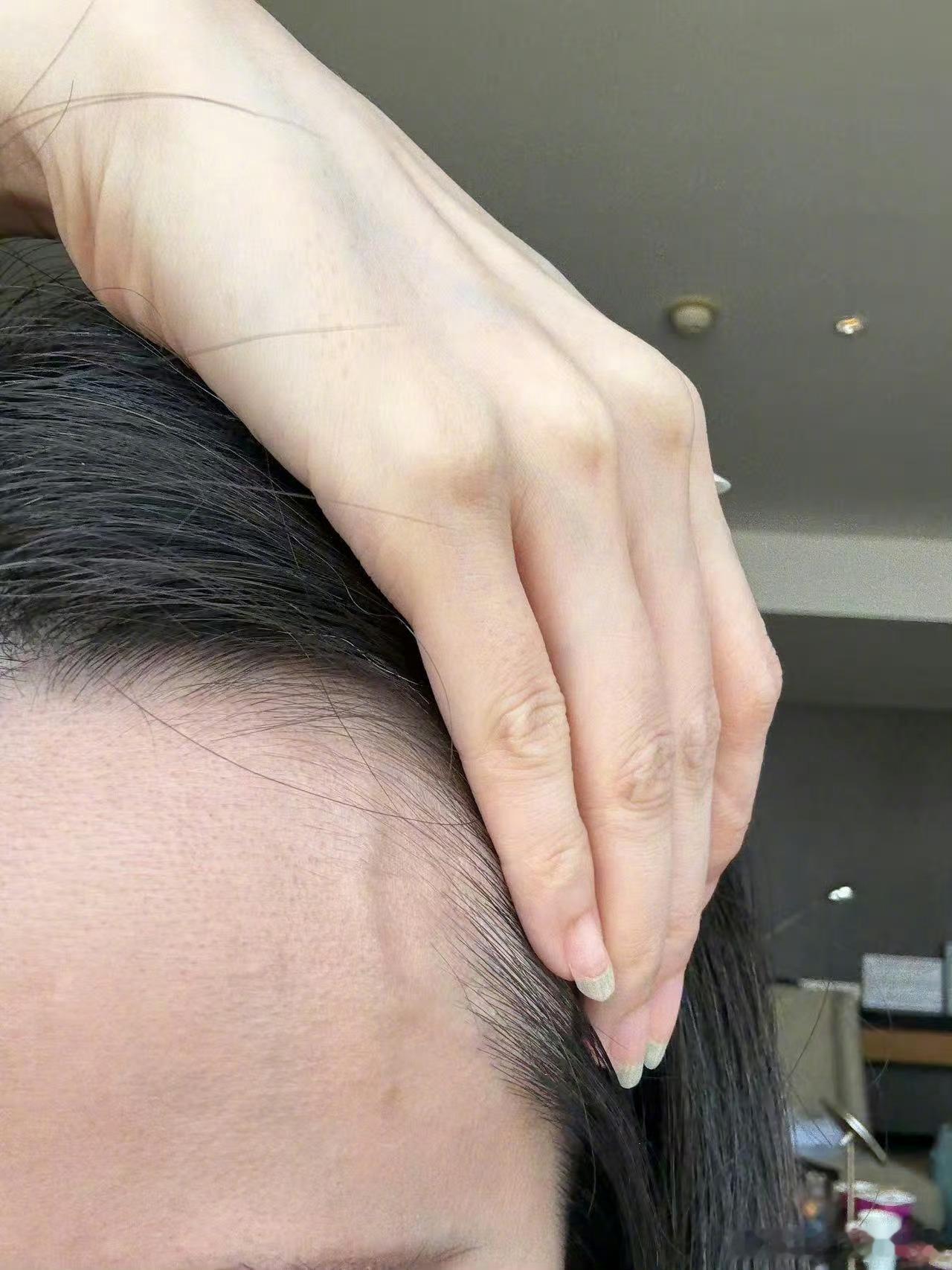 张靓颖说她伸个懒腰手掌就流血了😳😳还有休息不好额头上青筋会很明显。应