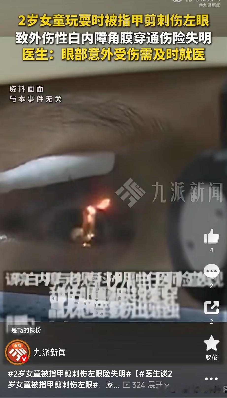 2岁女童被指甲剪刺穿眼球！武汉一个2岁的小女孩甜甜，就在自己家里，被一个再普