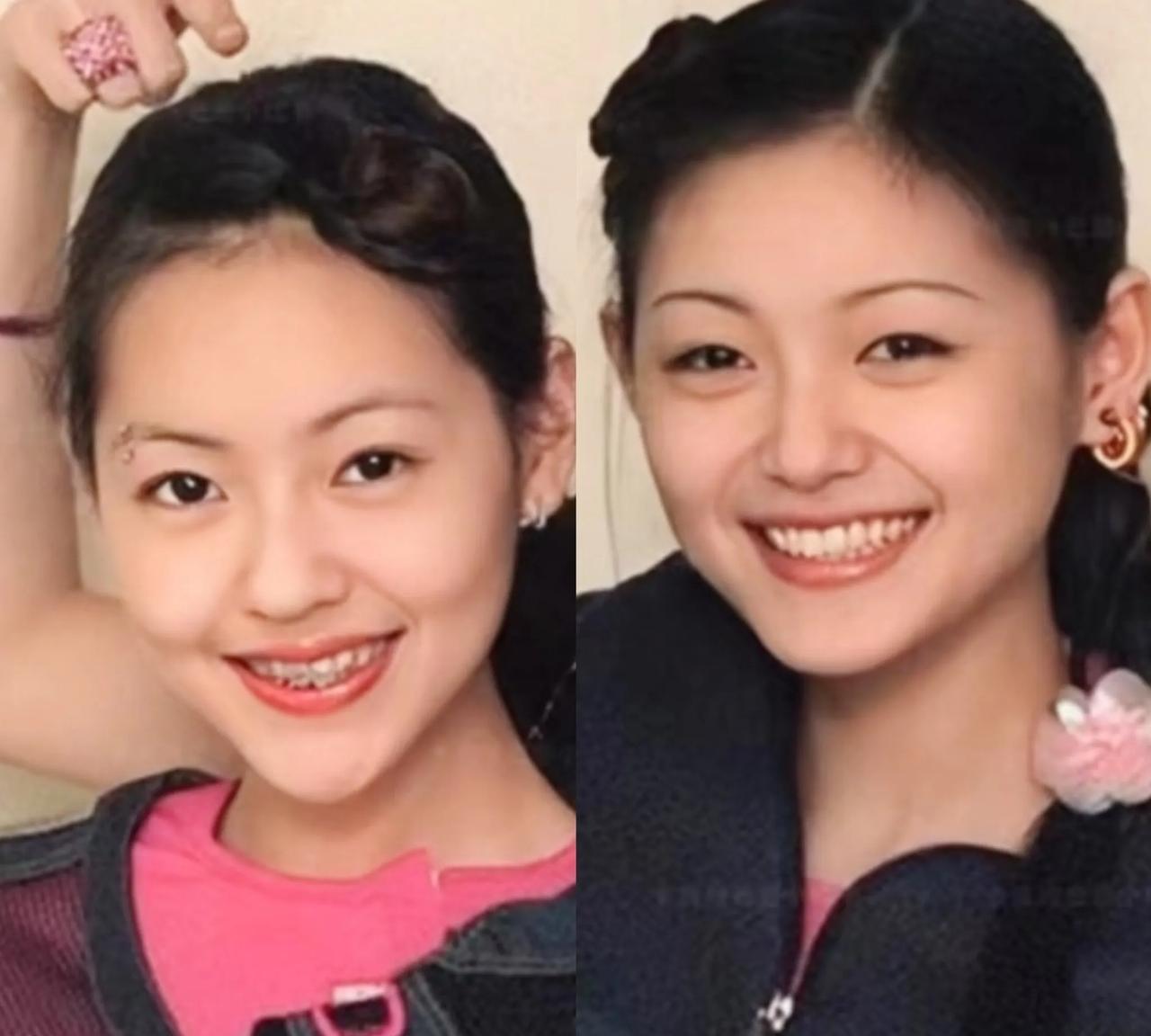 之前有说过虽然小S的鼻子没有大S的鼻子漂亮秀气，但小S的鼻子蒜头比较大，按有很多