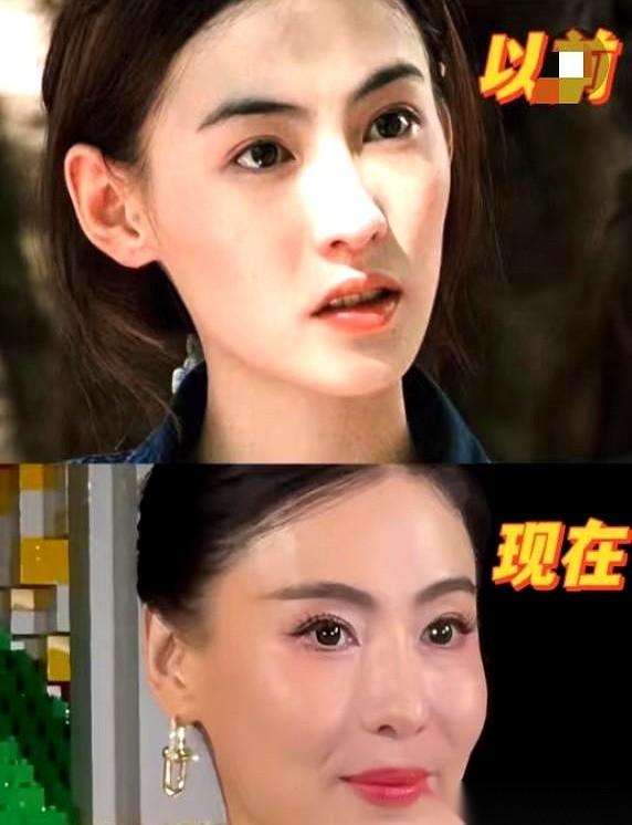 我跟你说个扎心的事儿。你去看张柏芝现在的脸，平滑得像剥了壳的鸡蛋，一条纹路都找