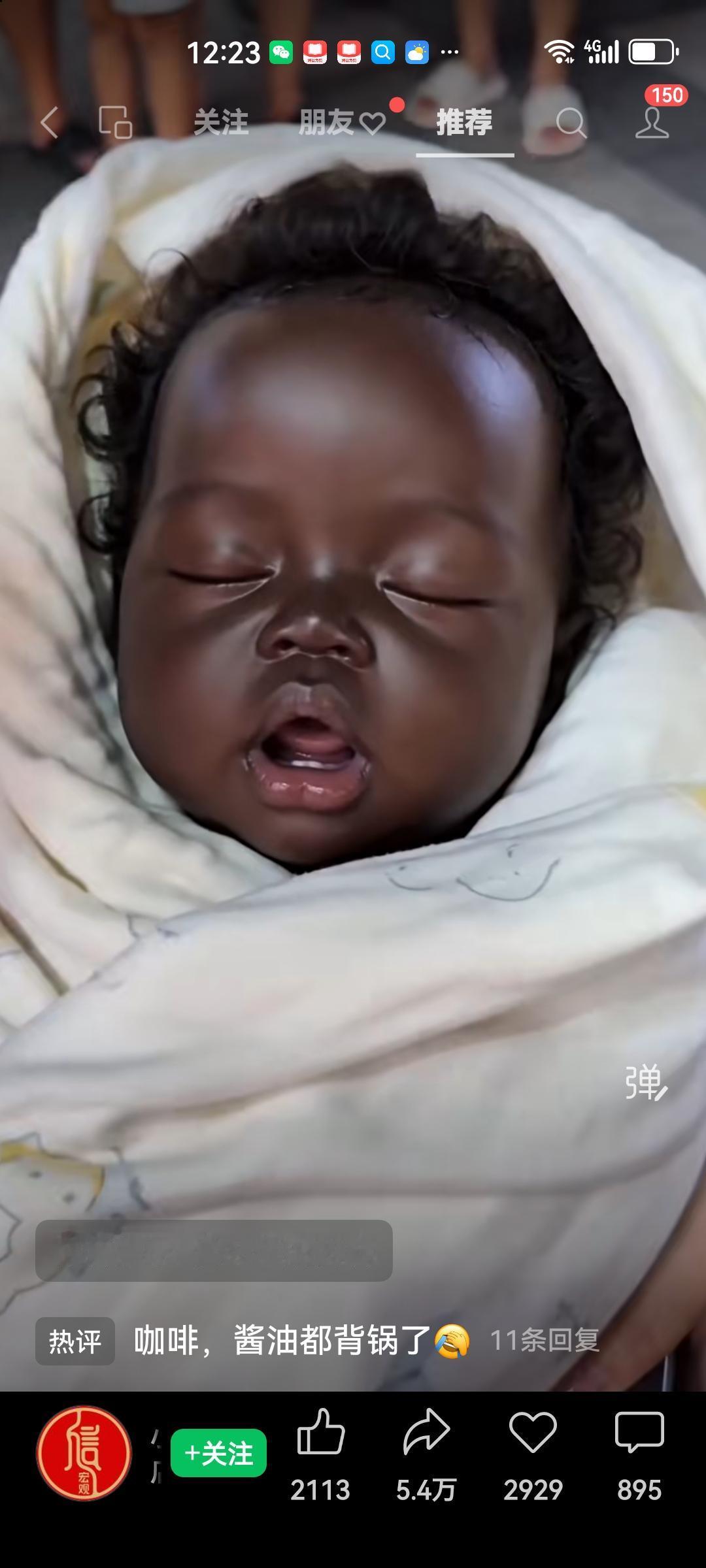 一位女士在医院分娩，顺利产下一个活泼健康的小男孩。只是这孩子的长相有些特别，如下