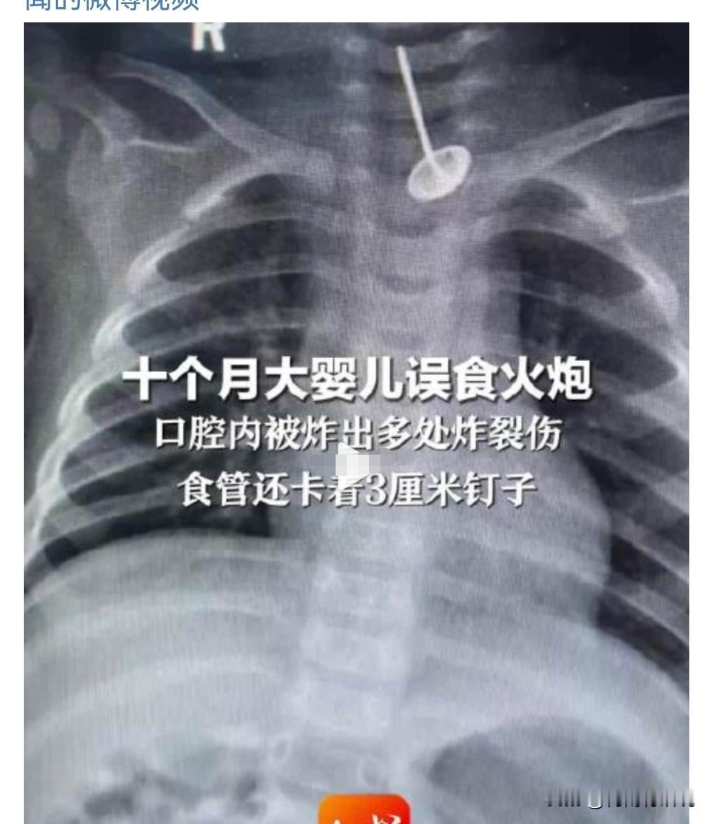 这真的是太危险了，太可怕了。1月14日晚，10月大婴儿误食鞭炮，口腔炸伤，更