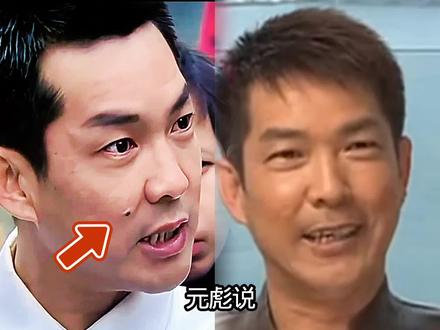 元彪说，去掉脸上的痣后，没人认识他了！