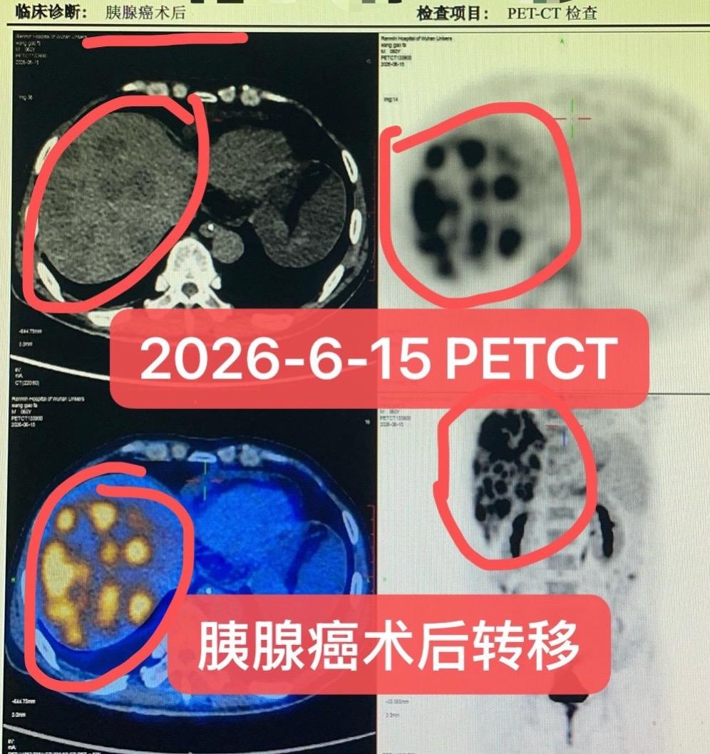胰腺癌术后广泛转移肝转移。胰腺癌，病理：中低分化腺癌，部分呈肉瘤样癌形...