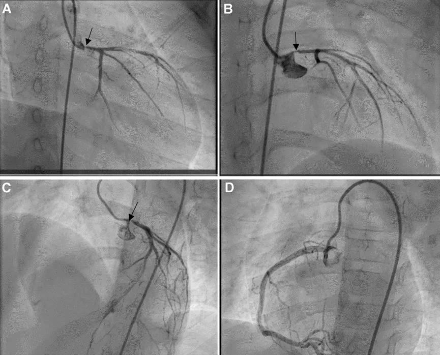 前几天看到一个7岁女孩因为胸痛突发心肌梗塞的报道，起因是低密度脂蛋白竟然高达