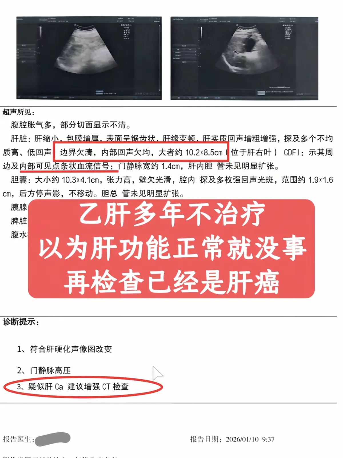 “20岁时候就知道自己有乙肝，但当地医生说我肝功能正常，就是乙肝携带者...