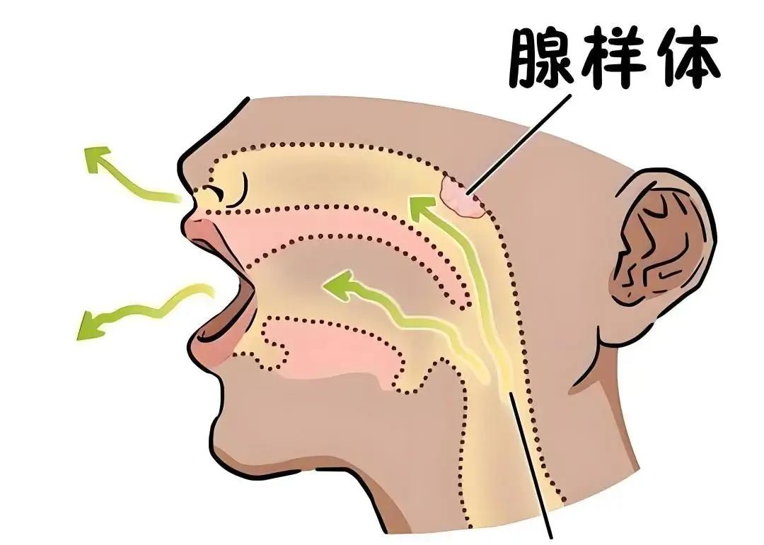 【孩子腺样体肥大，睡前这个习惯，看似正常，实则发病！】大家好，我是孟牛安。很
