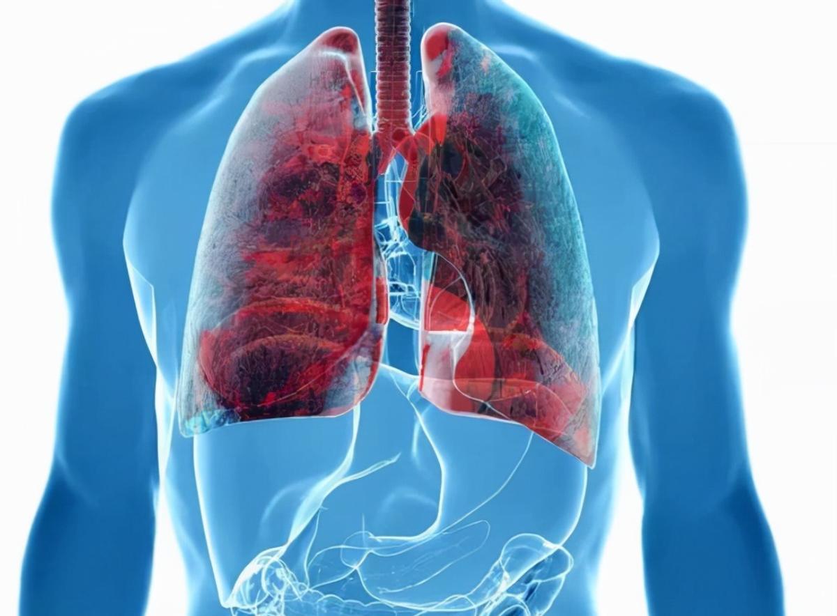 肺癌都是拖出来的？医生：身上若有2痛1凸，早做筛查为妙咳嗽总不好、肩膀总酸、
