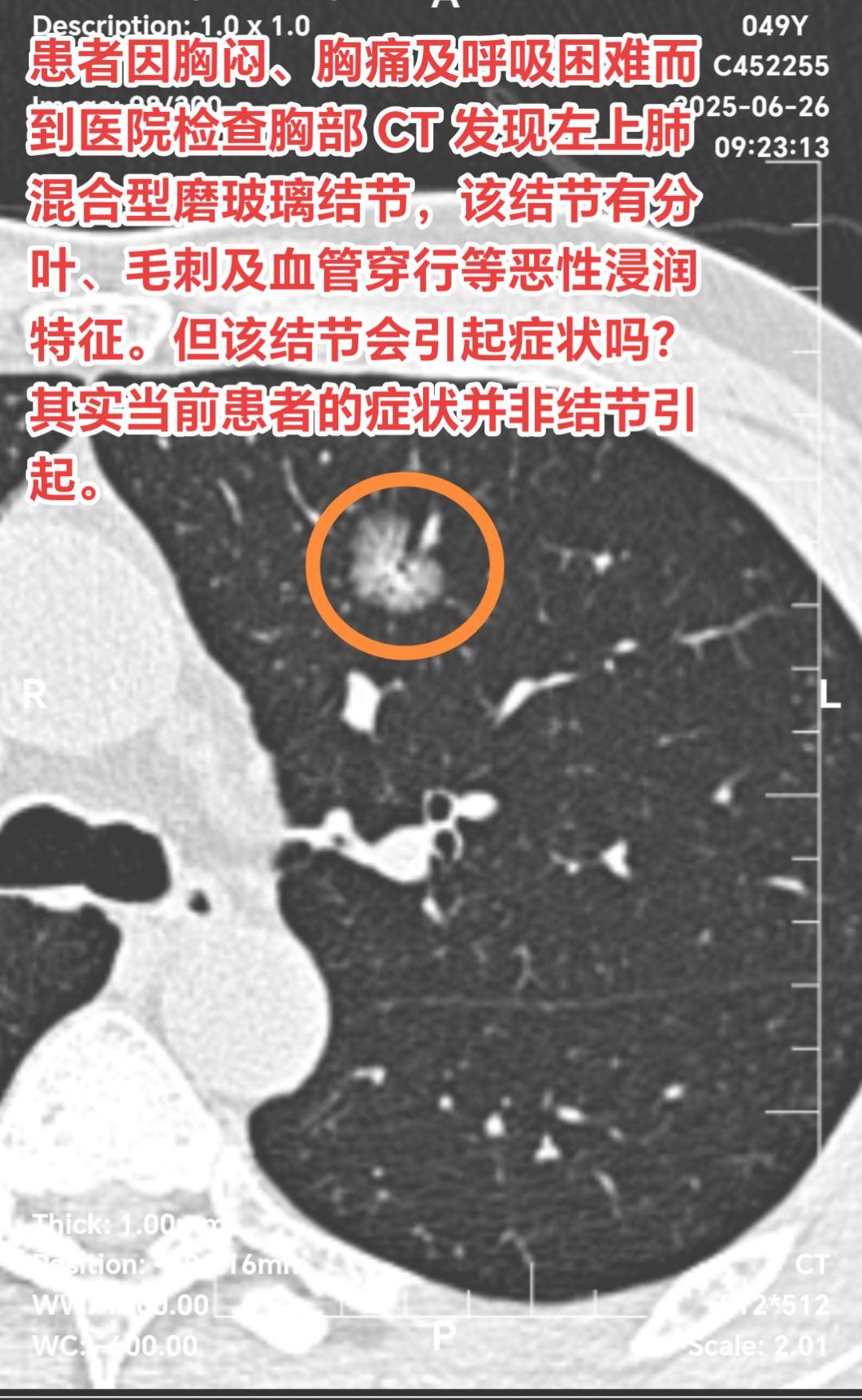 肺结节与胸痛、胸闷的偶遇但并没关系。患者因胸闷、胸痛及呼吸困难而到医院...