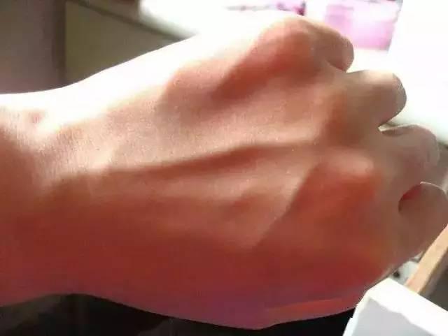 这个部位“青筋暴突”, 可能你的肝已经硬化.......