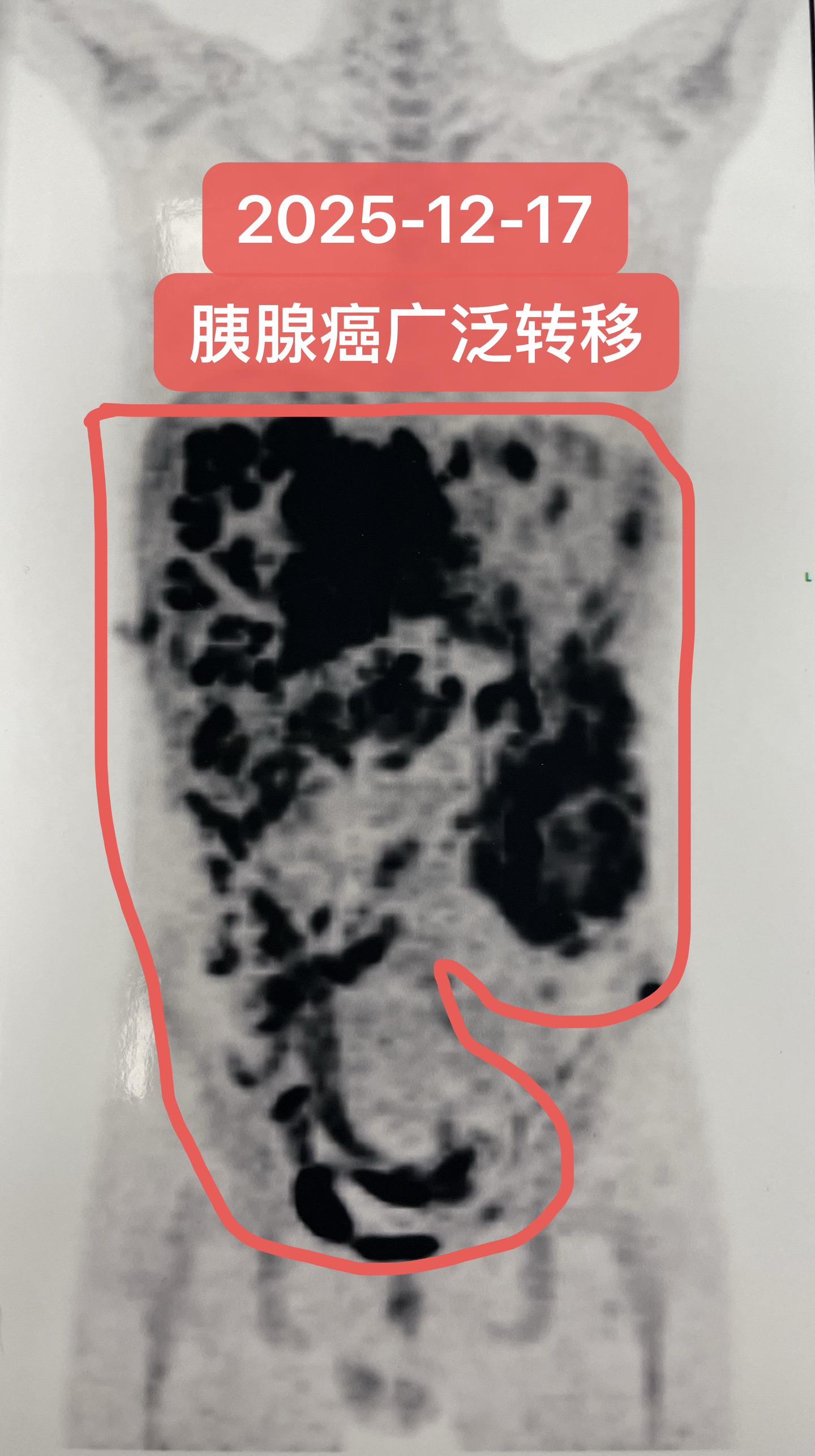 胰腺癌肝、肺、骨及淋巴结广泛转移。肝脏几乎被肿瘤吞噬！治疗难度很大！常...