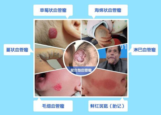专家解读! 血管瘤到底能根治吗? 血管瘤手术又要多少钱呢?