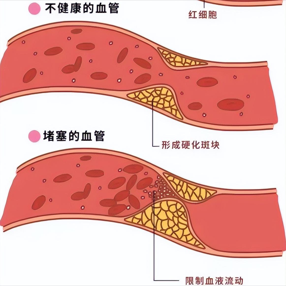 血管堵没堵，身体早知道！这4个信号出现一个，都别大意第一个信号：手脚老是发凉