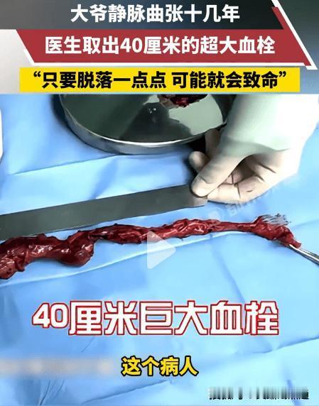 静脉曲张取出40厘米完整血栓事件原委（2026年6月全网热搜案例）一、患者基础