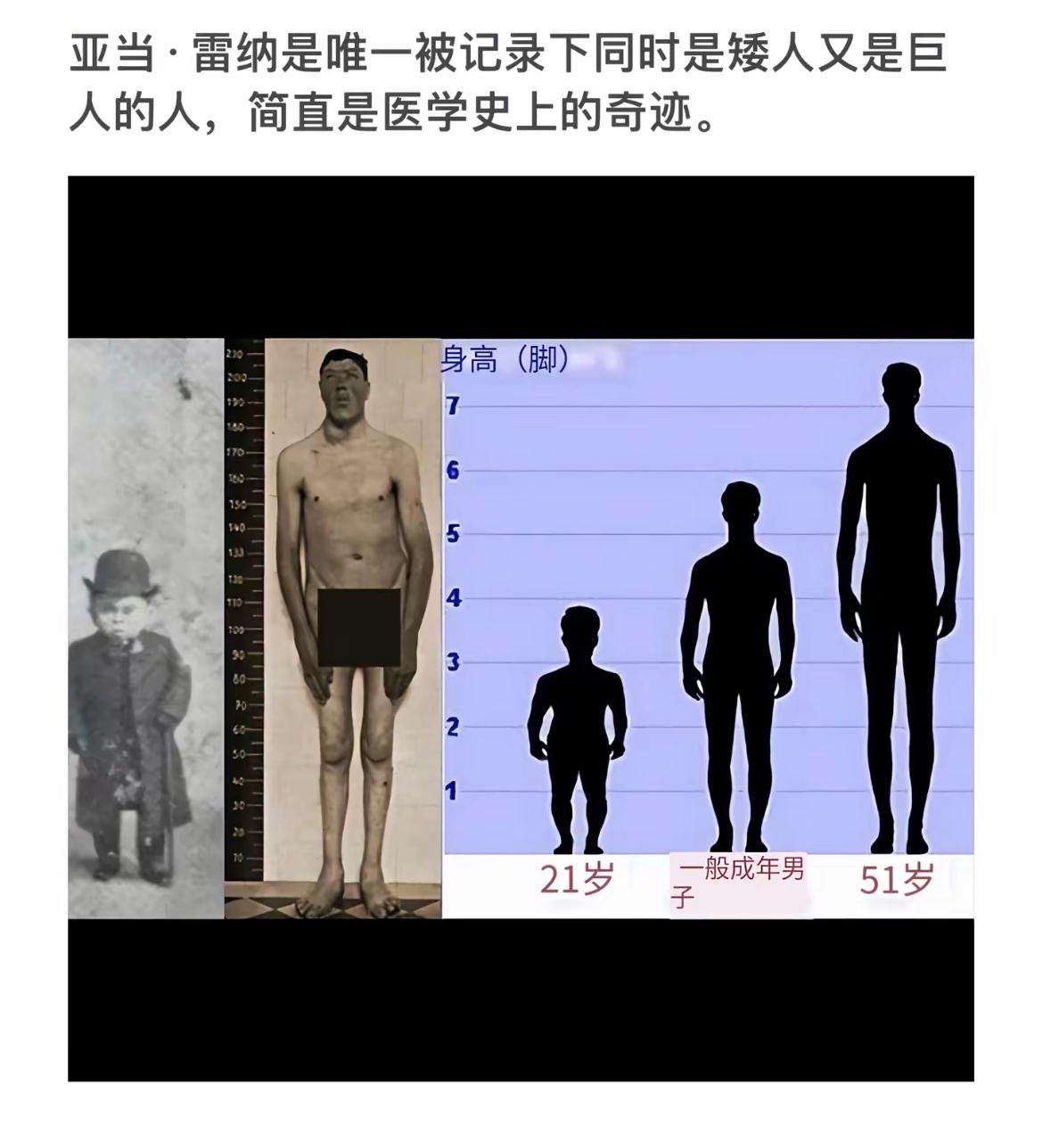 医学奇迹！亚当·雷纳：矮人巨人之谜