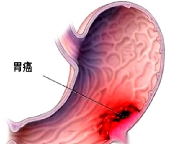 一个55岁的阿姨，胃癌晚期。她觉得这辈子就这样了，不想拖累孩子们，就偷偷买了包
