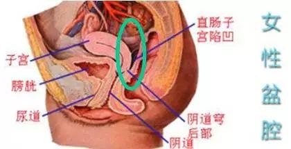 盆腔积液与备孕, 没你想得那么简单