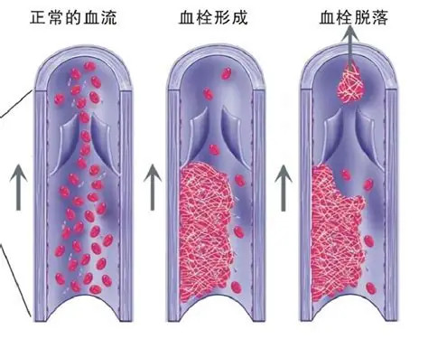 男子遭多次刑讯逼供后死亡11人被判刑新闻里说静脉血栓形成并脱落,一直没理解时候