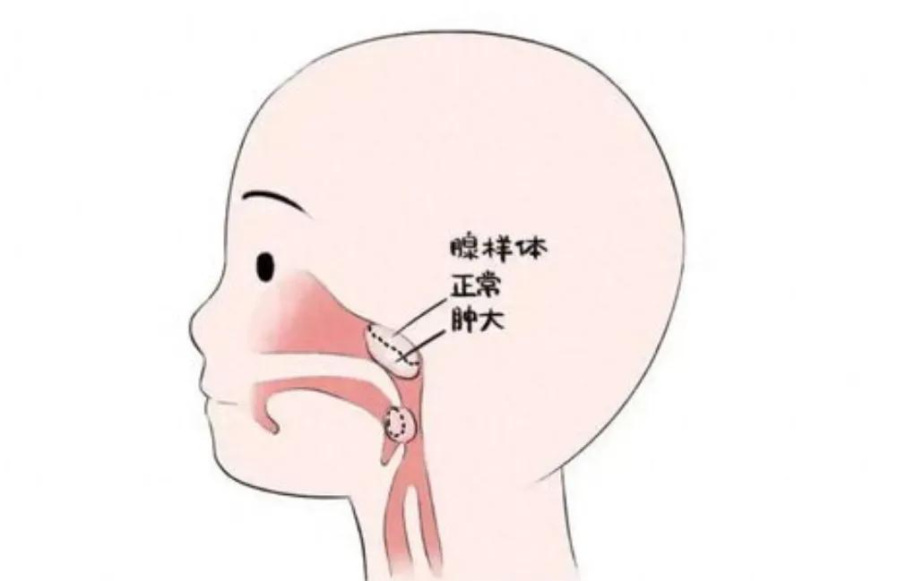 孩子腺样体肥大：入秋后把冷饮换成它，每天一碗，排尽全身湿热废水，呼吸顺畅了入秋
