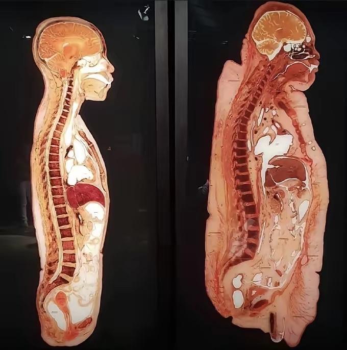 胖子和瘦子的差别
