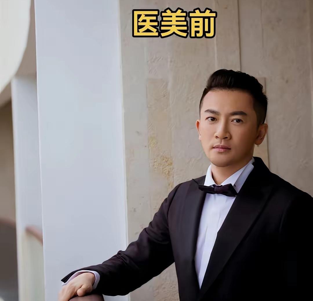 没有比较就没有伤害，看看苏有朋医美前后的变化，相信苏有朋想死的心都有。医美前是东