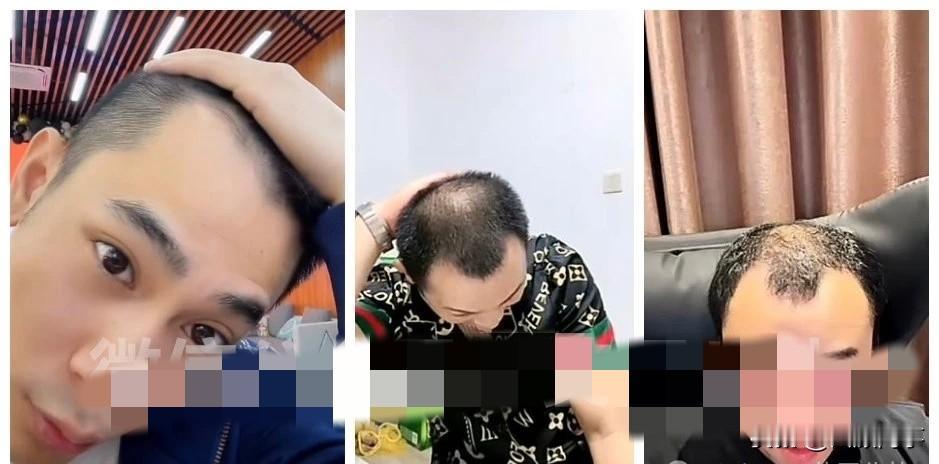 大哥、小弟秃顶严重，吴迪发际线后移显现！吴迪家族男性有