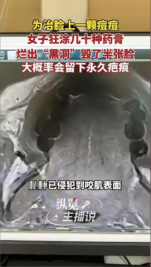 “真是个狠人！”5月19日报道，浙江杭州，一女子脸上长了个硬疙瘩，她以为是个痘，