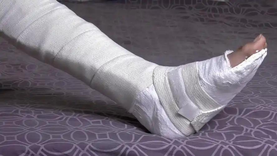 上海，女子出门时不慎从楼梯上摔倒，导致右腿粉碎性骨折，女子是公交司机，腿就是饭碗