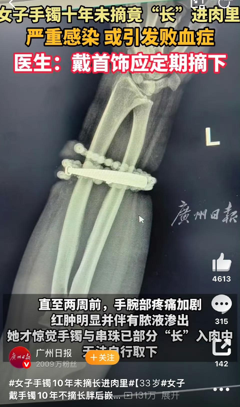 女子手镯10年未摘长进肉里手镯是死的人是活的，带着觉得不对劲的时候就应该摘下来