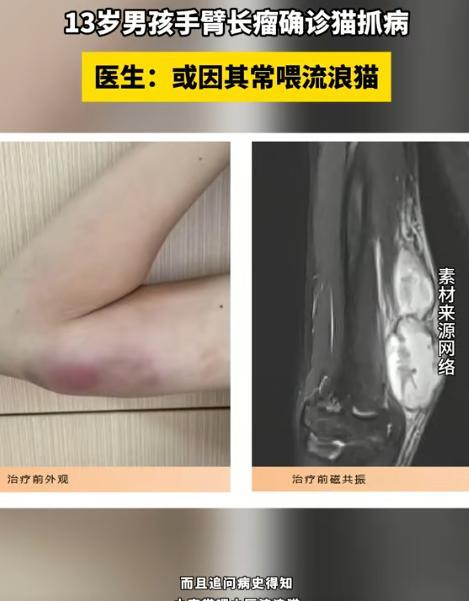 -太让人心惊了！近日，福建福州，一名13岁男孩经常投喂流浪猫，结果手臂上长出一颗