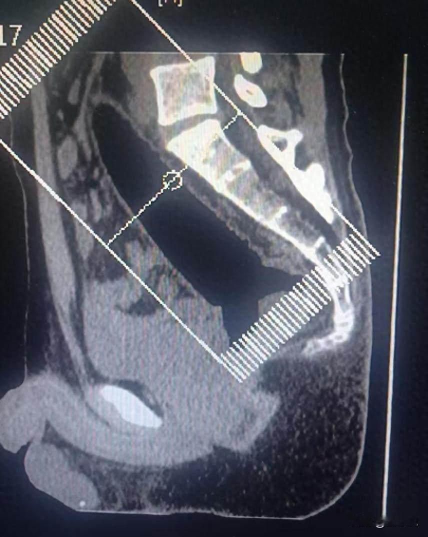 太离谱了！河南郑州，一男子捂着屁股去医院肛肠科看病，可问诊时，男子却扭扭捏捏说屁
