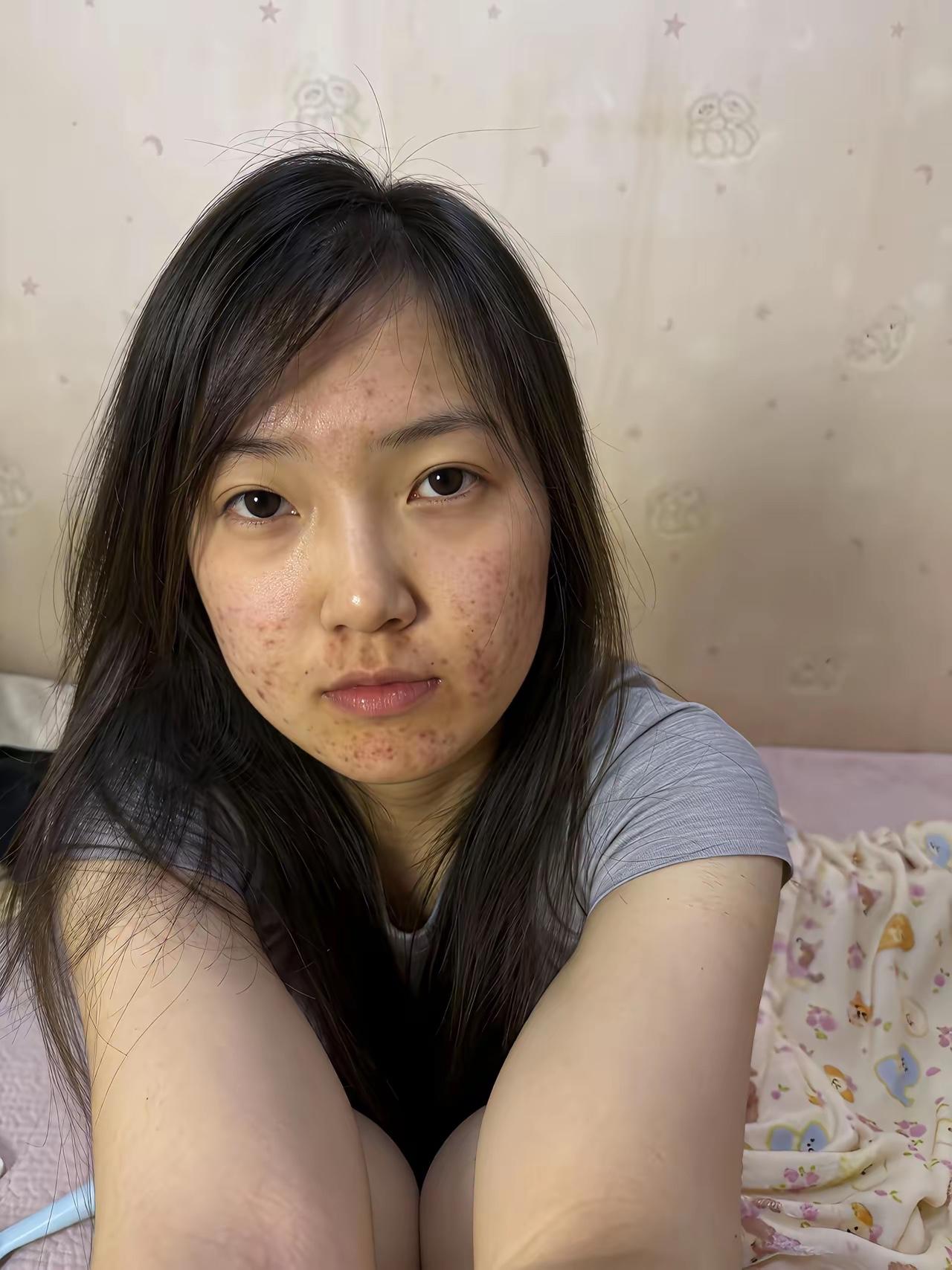 美女朋友的蜕变曾经因为脸上的痘痘被前男友抛弃了看现在的她是不是很挺漂亮了